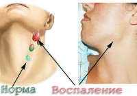 Болит лимфоузел и десна что делать Болит лимфоузел и десна что делать