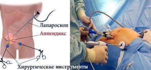 С какой стороны аппендицит у человека?